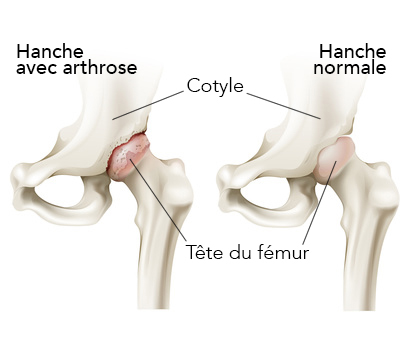 arthrose de la hanche schéma