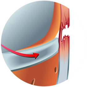 Ligamentoplastie - Dr Clavé Arnaud