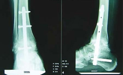 Arthrodèse de cheville - Dr Clavé à Nice