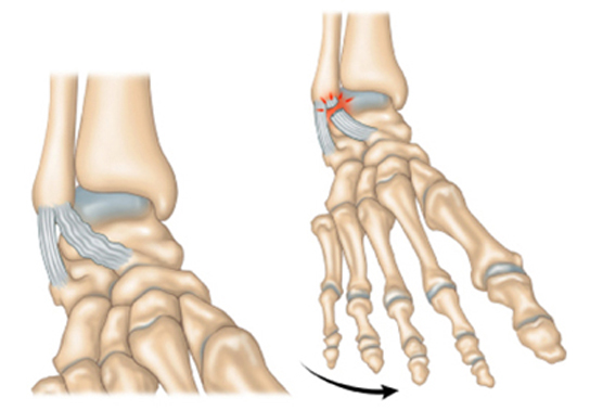 Problème ligaments cheville - Dr Clavé à Nice