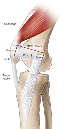 Reconstruction du ligament patello-féloral médial