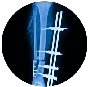 Ostéosynthèse de fracture - Dr Clavé Orthopédiste Nice