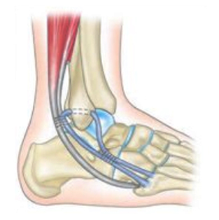 Réparation des ligaments cheville - Dr Clavé à Nice