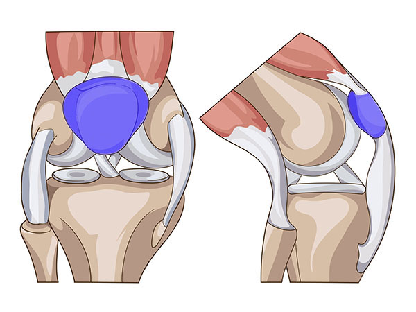 Chirurgie de la rotule - Chirurgie Orthopédique Nice - Dr Arnaud Clavé