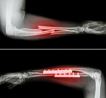 Ostéosynthèse de fracture