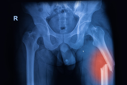 Ostéosynthèse de fracture - Chirurgie Orthopédique Nice - Dr ...