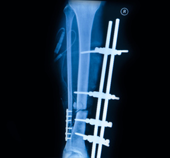 Ostéosynthèse de fracture - Chirurgie Orthopédique Nice - Dr ...