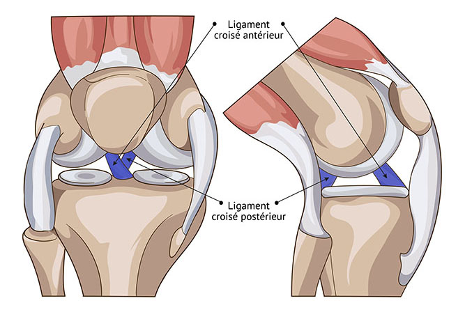 Déchirure des ligaments croisés antérieurs