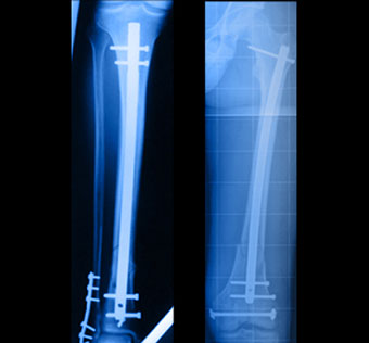 Clous ostéosynthese - Dr Clavé Arnaud Chirurgien orthopédique à Nice