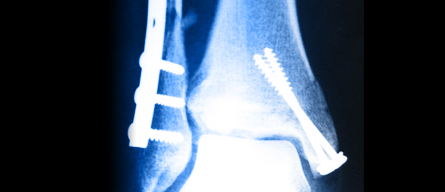 Ostéosynthèse de fracture - Chirurgie Orthopédique Nice - Dr ...